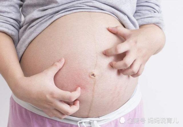 长妊娠纹的3个 信号 孕妈妈注意了 附防妊娠纹方法 妊娠纹 孕妈 孕期 肚皮