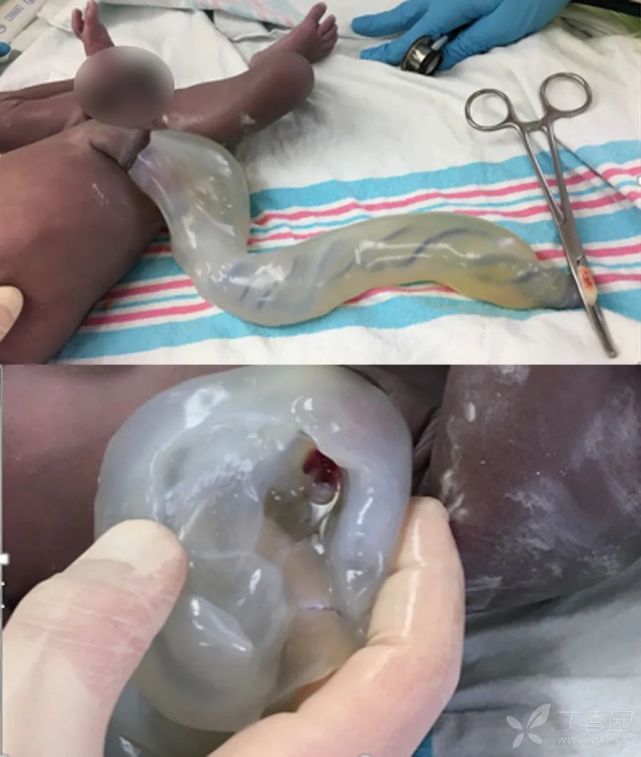 这么大的脐带,要不要外科治疗?