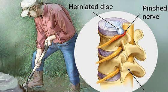 如果有腰间盘突出 仍然从事重体力劳动 会加重吗 医生告诉您 腾讯新闻