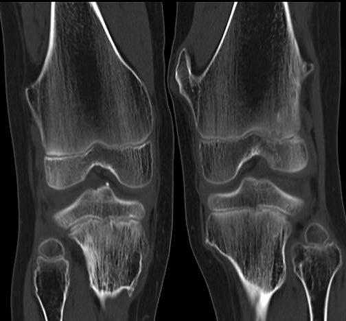 什么是外生性骨疣它会恶变吗如何治疗呢医生告诉您