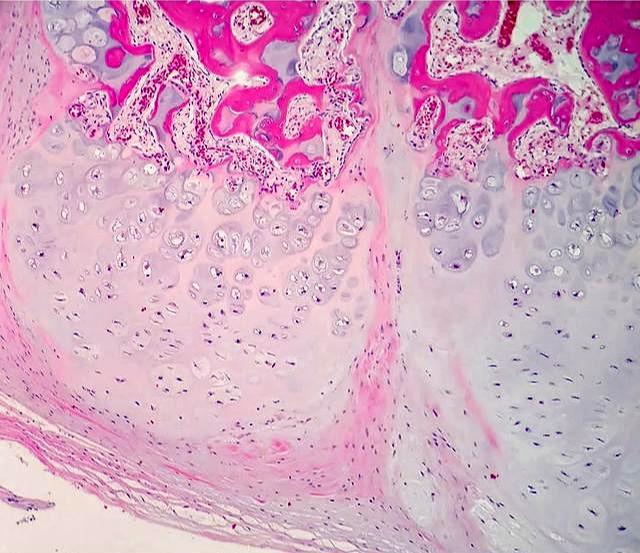 什么是外生性骨疣它会恶变吗如何治疗呢医生告诉您