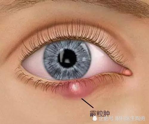 眼睛上有小疙瘩就是针眼 听陶勇医生讲如何区分麦粒肿和霰粒肿 腾讯新闻