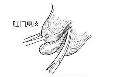 肛門息肉是什麼原因?