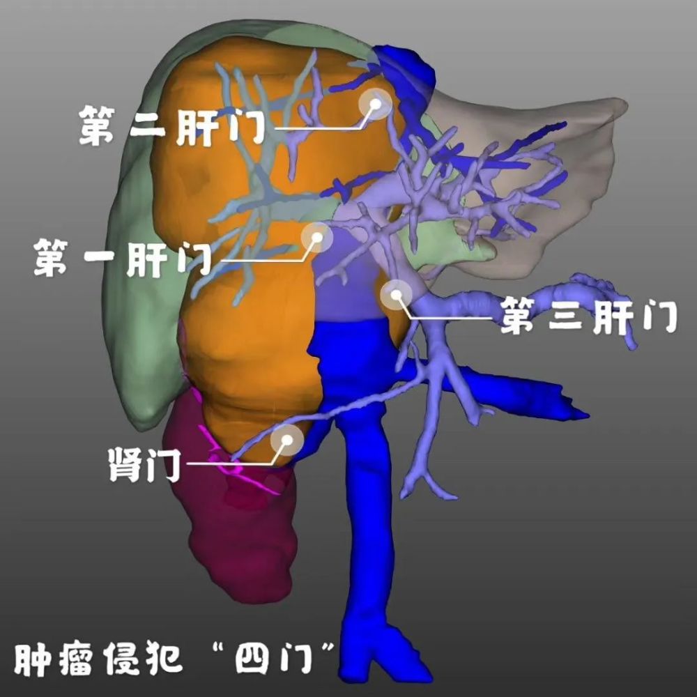 第三肝门立体图片图片