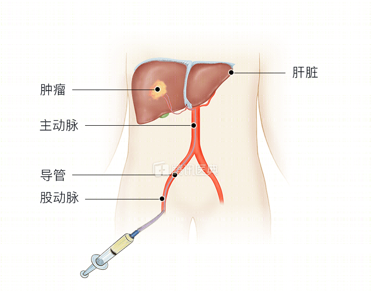 男子肝肿瘤大如橄榄球医生用13小时取出这种痛是肝脏在求救别忽视