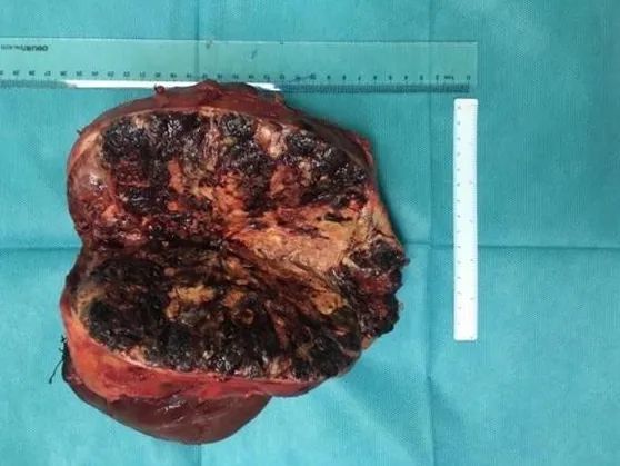 男子肝肿瘤大如橄榄球医生用13小时取出这种痛是肝脏在求救别忽视