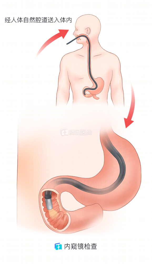 胃镜检查太痛苦能用钡餐造影替代吗看完优势和不足就有答案了