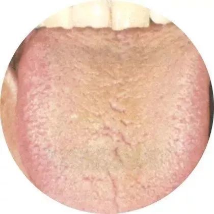 舌头,一旦出现这个信号,马上找中医!