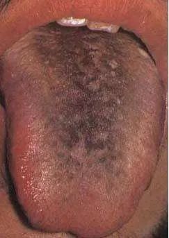 慢性病内脏衰竭,如肝硬化晚期肝功能严重损害,慢性肾功能衰竭尿毒症