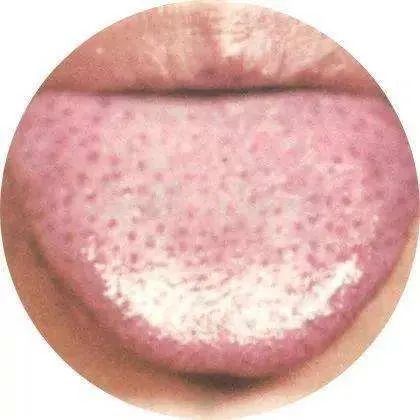 舌头一旦出现这个信号疾病找上门