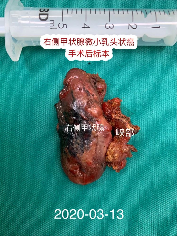 甲状腺峡部结节图片图片