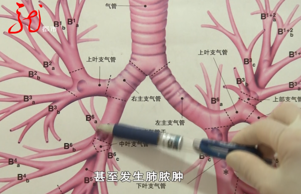 这块下边的气管阻塞之后,就会发生阻塞性肺炎,甚至发生肺脓肿,(异物)