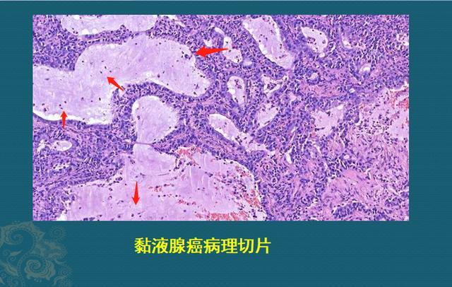 肺癌误诊2个月,不是医生无能,这个癌细胞太会伪装了
