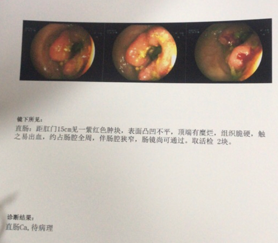 封村半个月,32岁妻子已是结肠癌晚期,疫情下的坎坷就医路