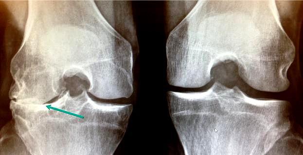 人老腿先老,中老年人如何预防膝关节骨关节炎呢?医生详细告诉您