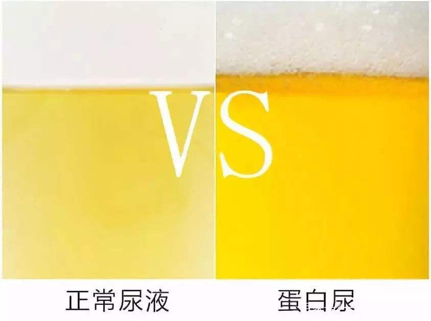 尿色颜色很黄不要再不管不顾了会不会是肾有问题