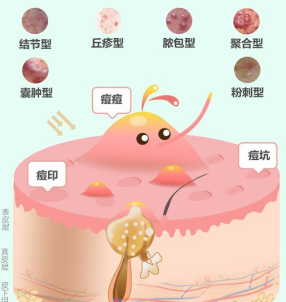 痤瘡反覆出現對症是關鍵預防醫治痤瘡前先了解痤瘡類型