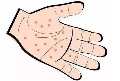 汗疱疹是湿疹吗症状有哪些应该如何预防