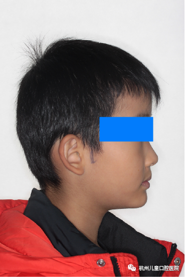 当降低颌垫的过程中观察下颌前伸的不良习惯是否已改正,如不能自