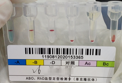 图1门诊患者,女性,52岁,来院检测血型和尿常规.