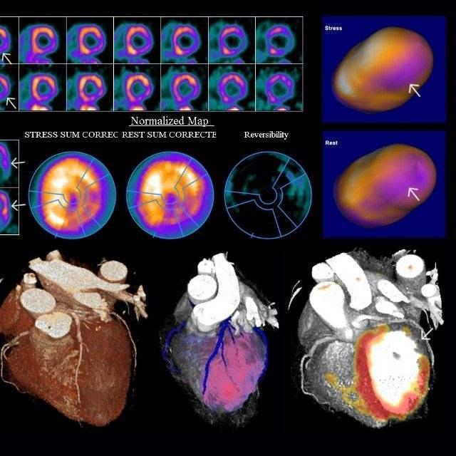 冠心病检查不仅只有造影这些更便宜更有效的检查门诊就能做值得收藏