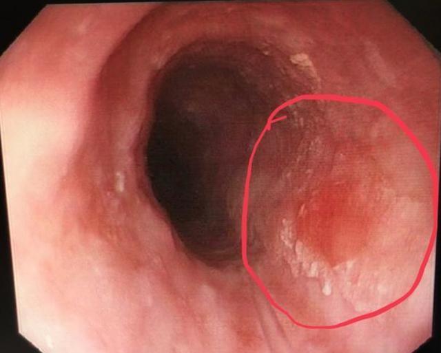 早期食管癌做胃镜能不能筛查到?医生告诉你:可以的!