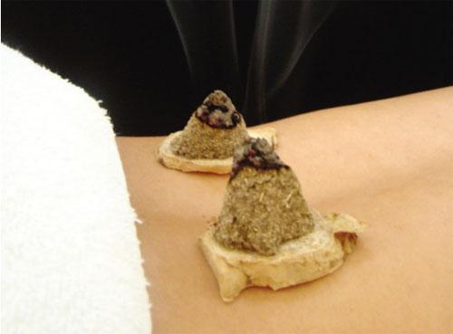 隔姜灸|艾柱|脏腑|隔蒜灸|附子|大蒜|姜片|生姜