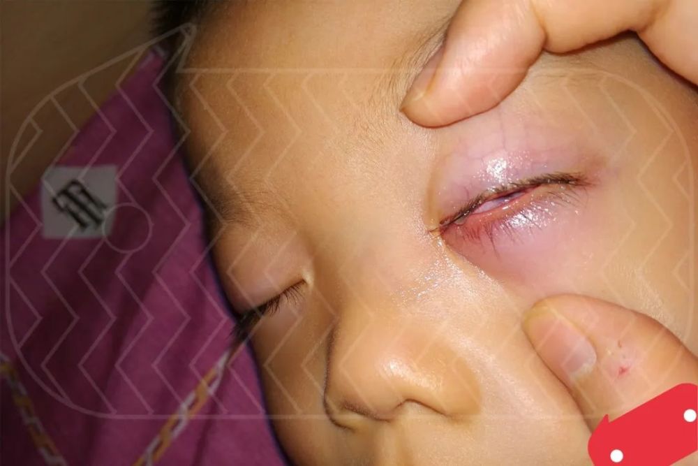 宝宝眼睛红肿千万别乱用药正确用药方法看这里