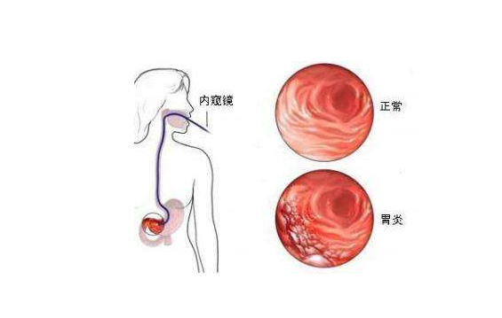 贲门炎的症状图片图片