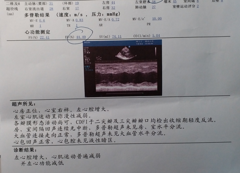 抑制心脏重构,从根本逆转心衰