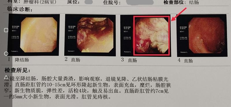 自行去药店买痔疮药却仍便血,一查才知是大肠癌_腾讯新闻