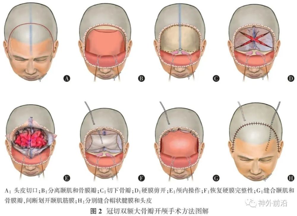 科室见面会|专访天坛医院刘佰运:大骨瓣减压手术会造