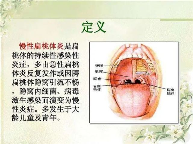 当扁桃体成为我们的"敌人"时|腭扁桃体|扁桃体炎