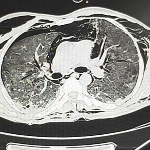 图4 轴向hrct显示纵隔气肿,右气胸和广泛的皮下气肿.