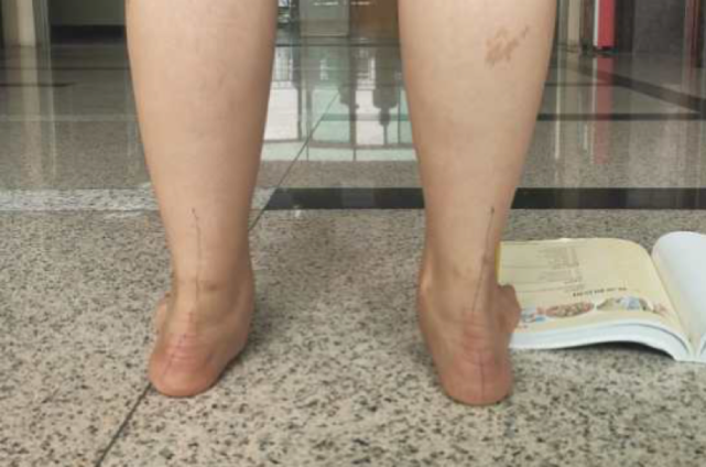 患者的足部外翻症状