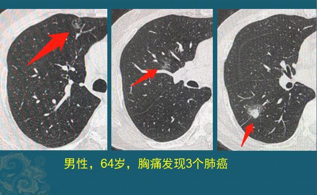 肺结节微创手术：呼吸健康的守护者