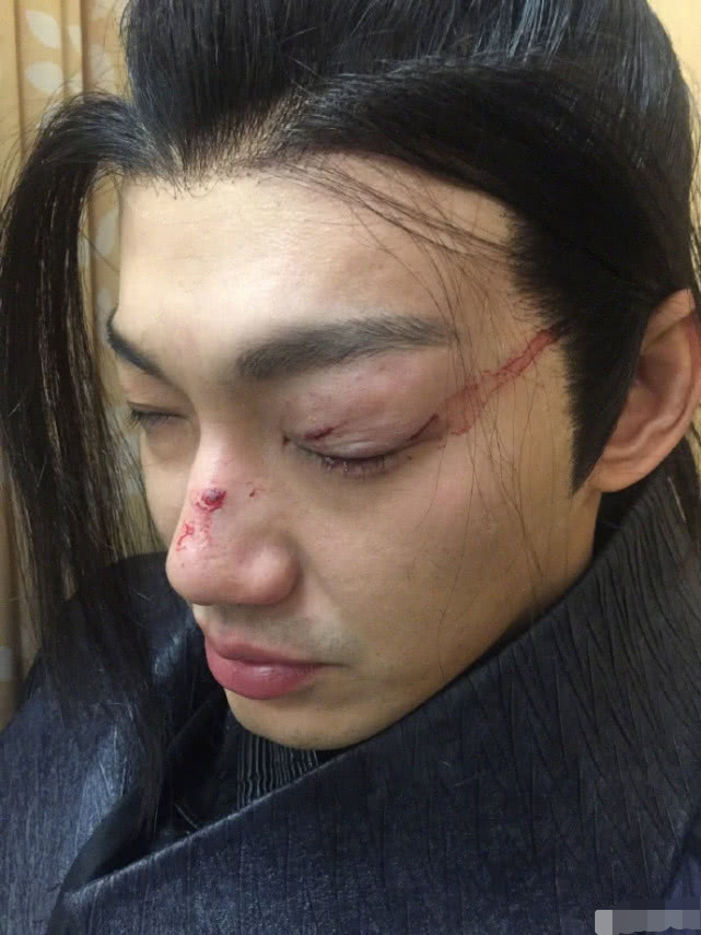 吴克群在微博上透露,棒棒堂成员威廉在拍戏时眼睛被木剑打到.