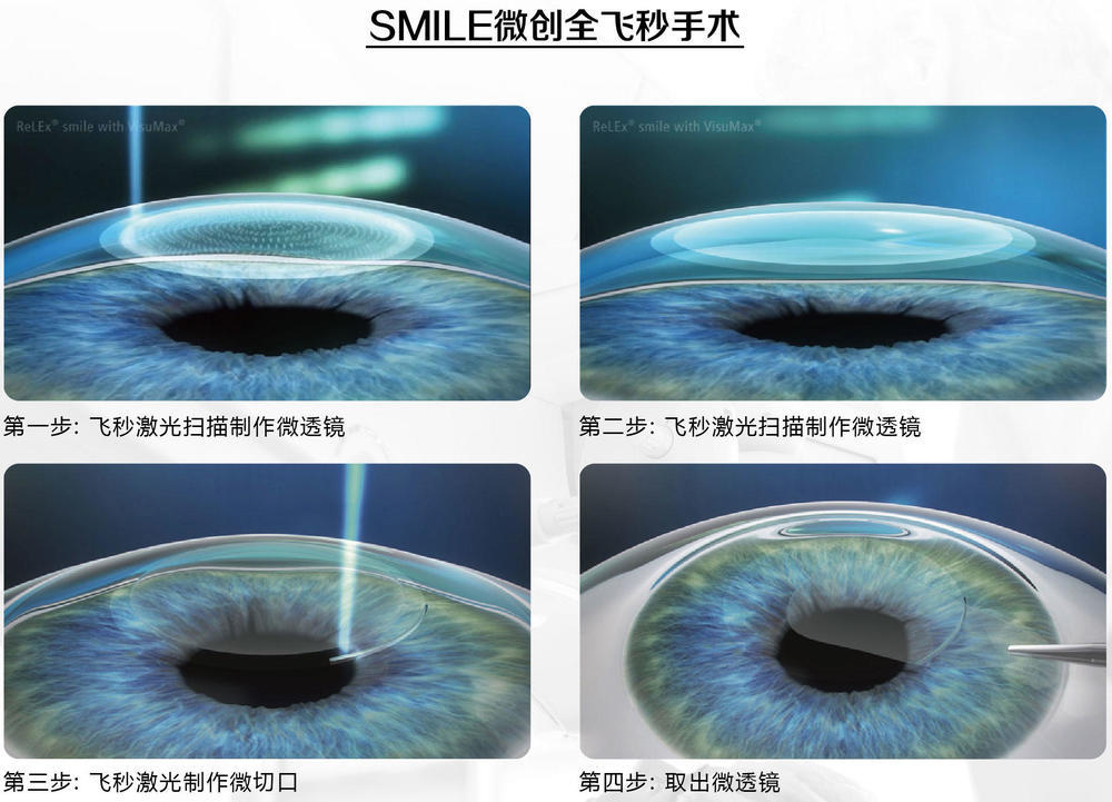 做近視手術疼嗎?東莞華廈眼科醫院梁秀棟院長科普