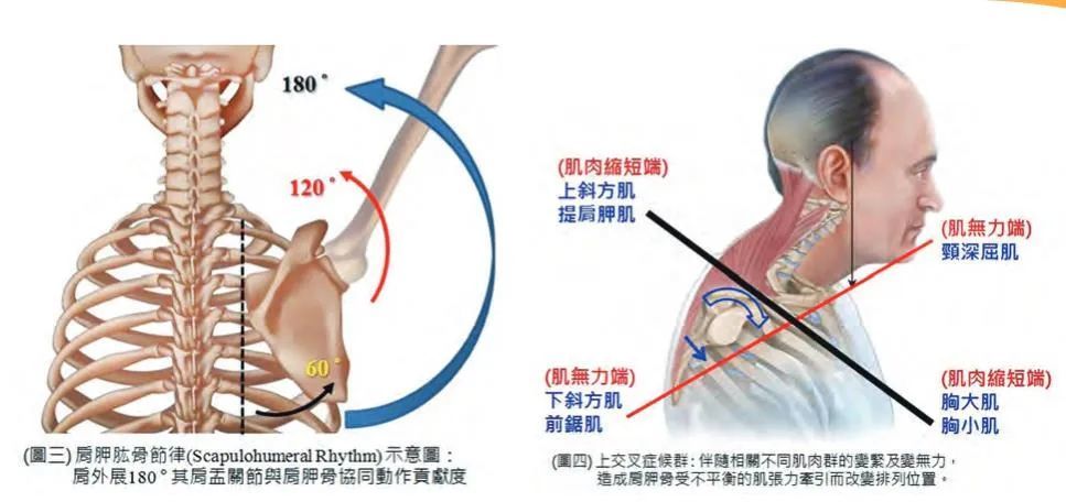 浅谈驼背与肩关节伤害 腾讯新闻