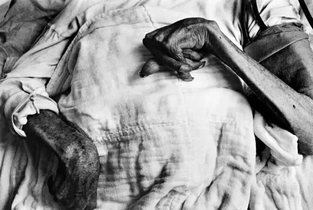 1972年,日本,一位水俣病患者