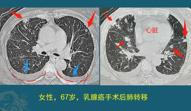 查出多發肺轉移和雙側胸腔積液:這是一位67歲女性,3年輕查出乳腺癌,做