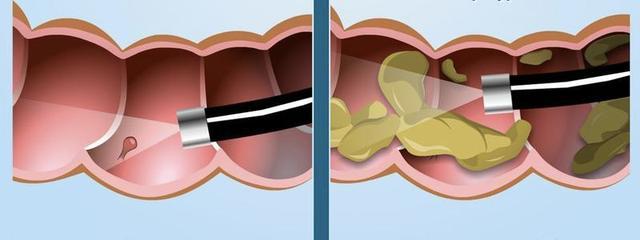 清肠做不好肠镜检查漏诊率达354个准备技巧让你放心接受检查