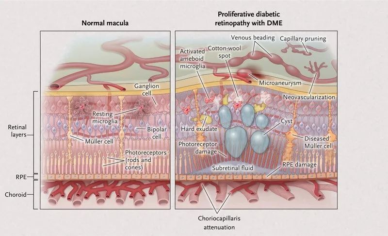 nejm糖尿病視網膜病變的護理與治療