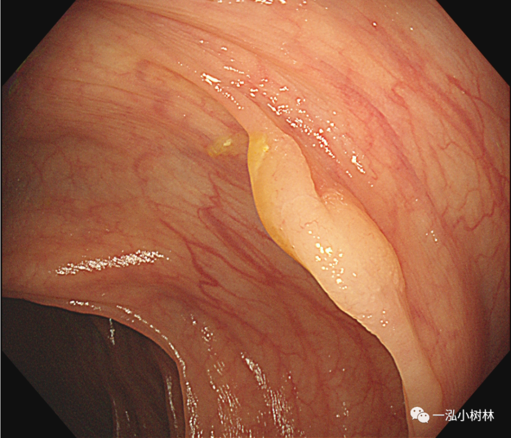 常见的大肠癌癌前病变 结肠息肉 腾讯新闻