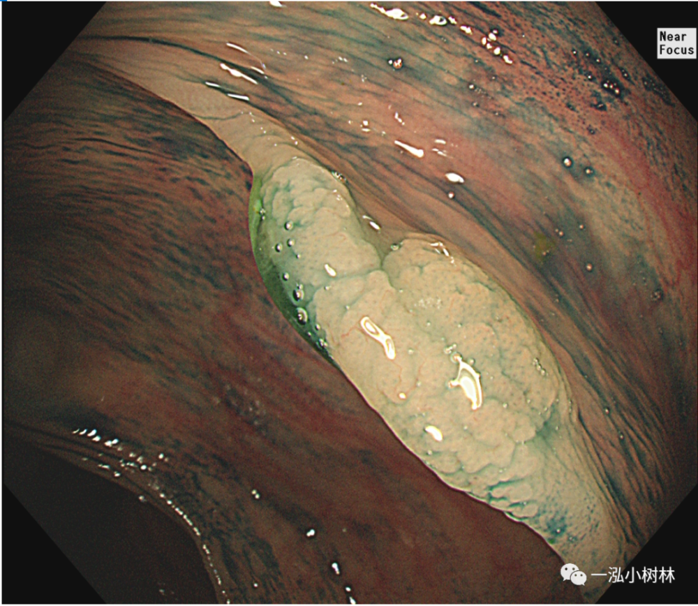 常见的大肠癌癌前病变结肠息肉