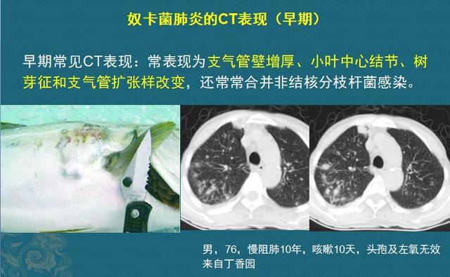周围小叶中心性结节,多发树芽征,支气管扩张等,跟其他的化脓性肺炎