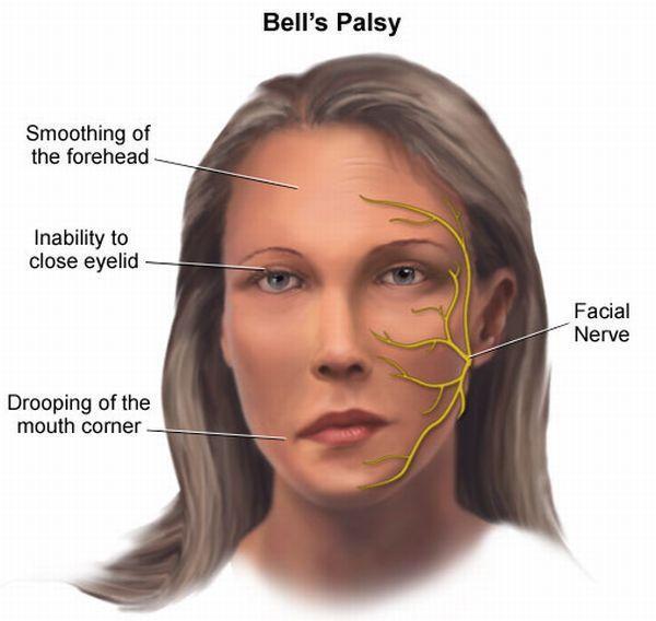 什麼是面癱醫生口角歪斜難閉眼這些原因致面癱