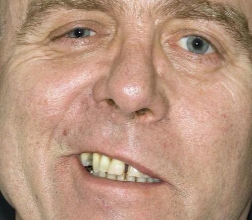 什么是"面瘫"?——医生:口角歪斜难闭眼,这些原因致面瘫