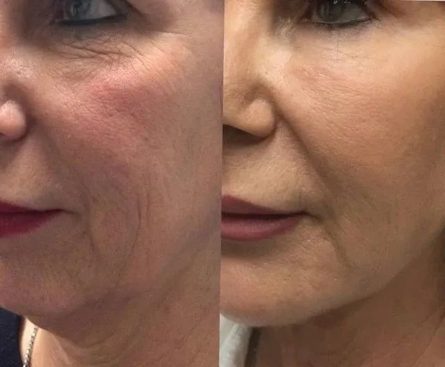 这个也好理解,他们破颧纹的形成原因还有一部分是韧带对真皮的牵拉