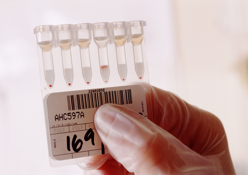 咽拭子检测|咽拭子检测为阳性即确诊新冠肺炎？早发现早隔离才是关键，别搞错了